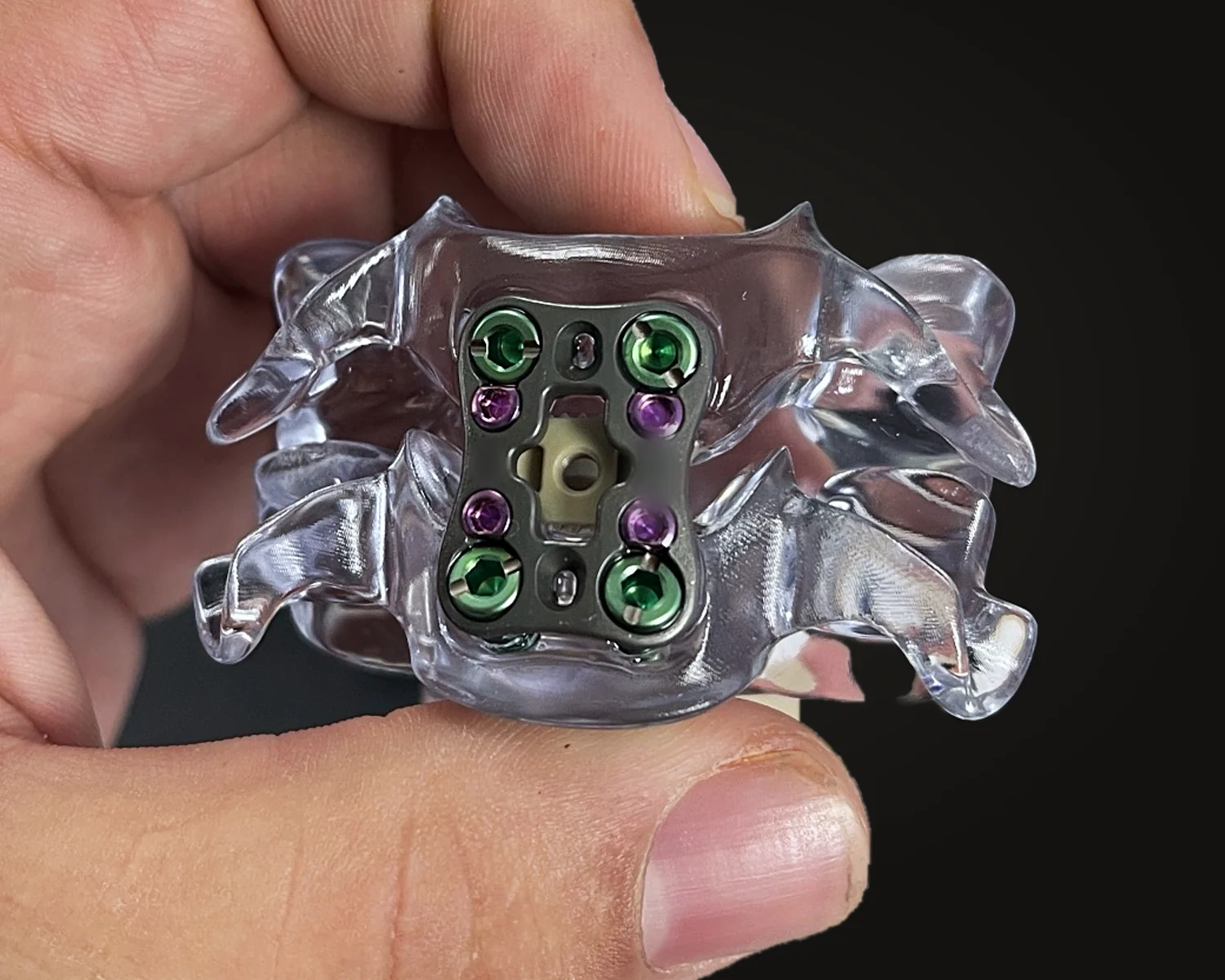 Two-level lumbar model with an anterior plate over an interbody spacer