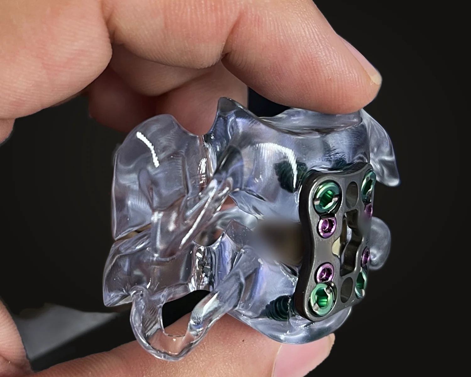 The same lumbar segment from an angle, spacer visible through the clear resin