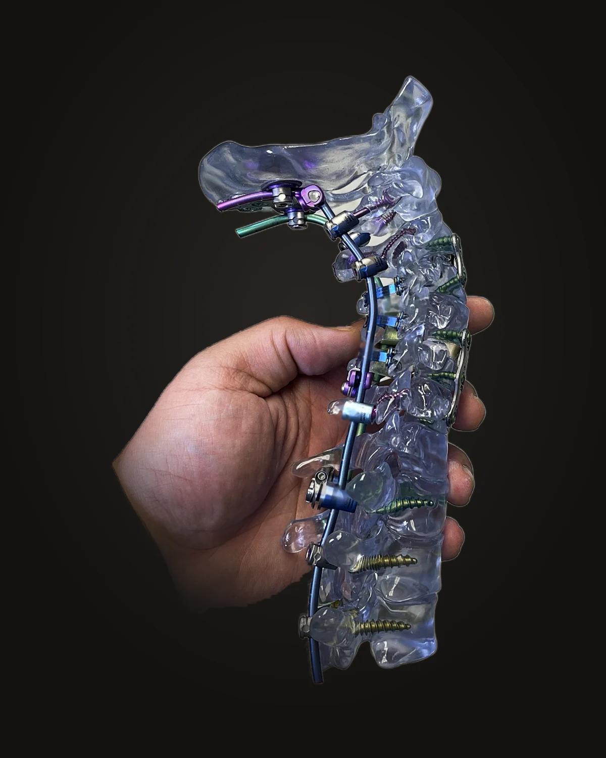 Clear resin occiput-to-thoracic spine display model with anodized rods and screws, held in hand